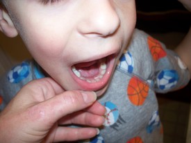 Sat 12 Jun 2010 08:07:56 PM

Andrew's fist adult tooth breaks the surface -- bottom left.